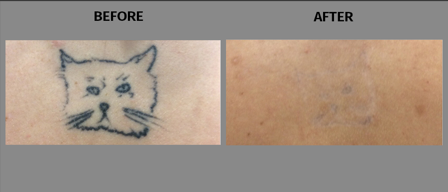 Closeup of skin patch with before and after of laser tattoo removal of a badly drawn cat tattoo