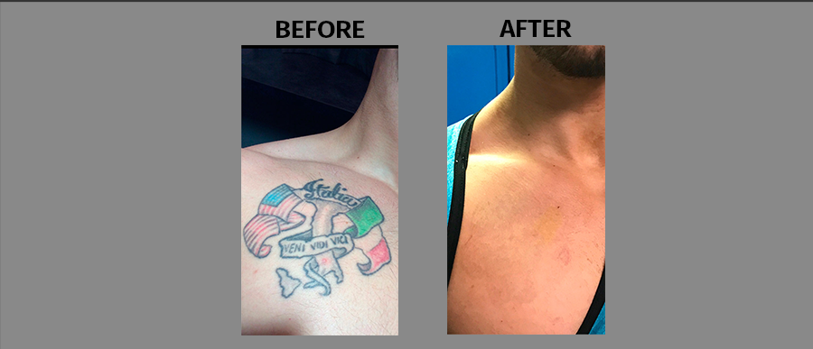 Before and after of man's chest of laser tattoo removal of a country tattoo