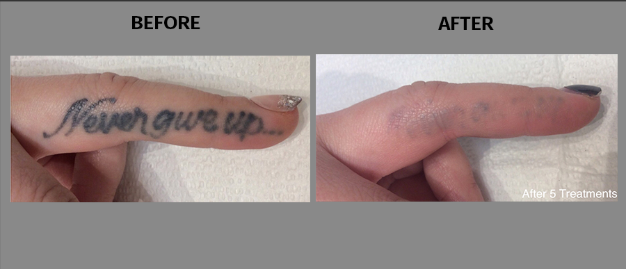 Before and after of laser tattoo removal on someone's finger