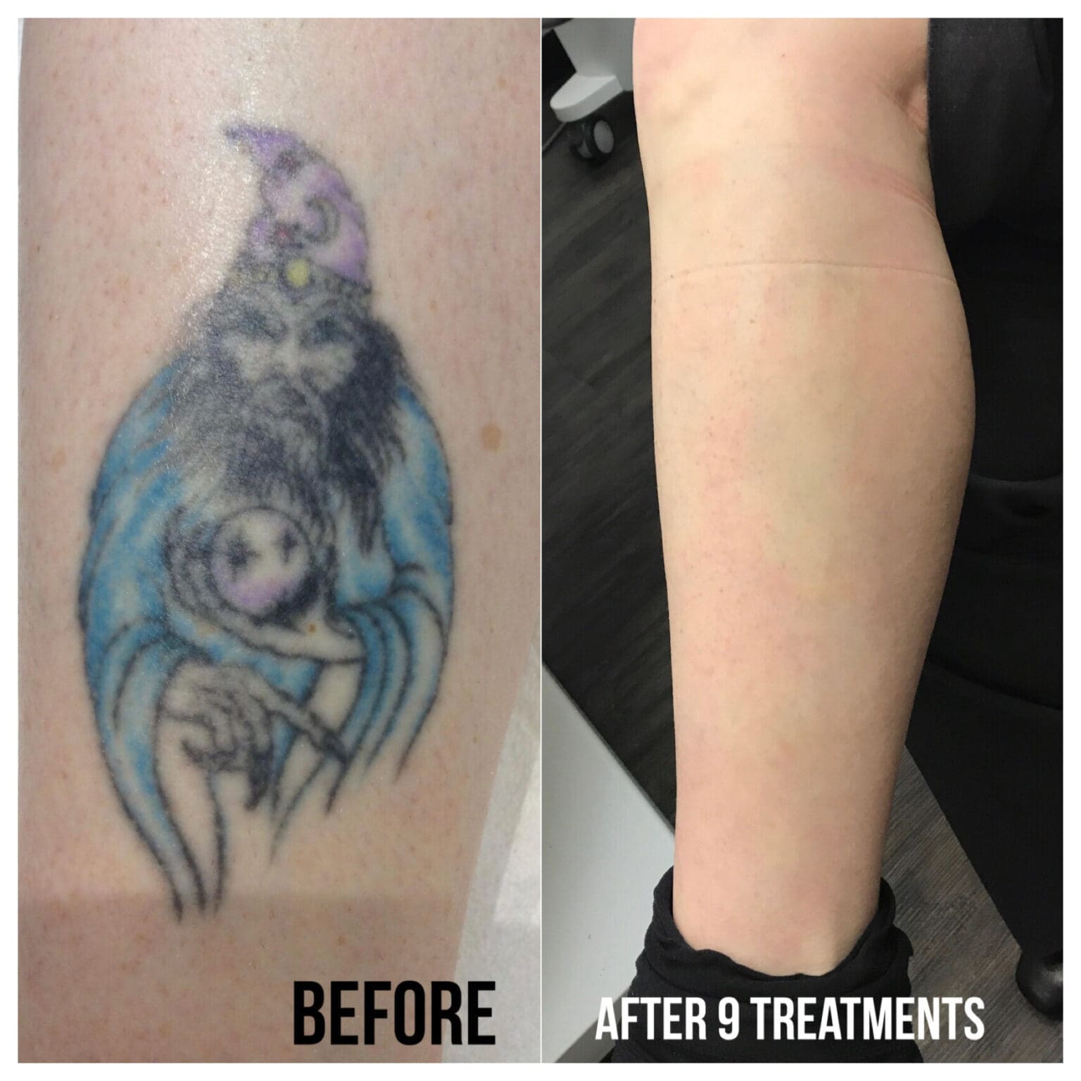 Laser Tattoo Removal IOIO Studio